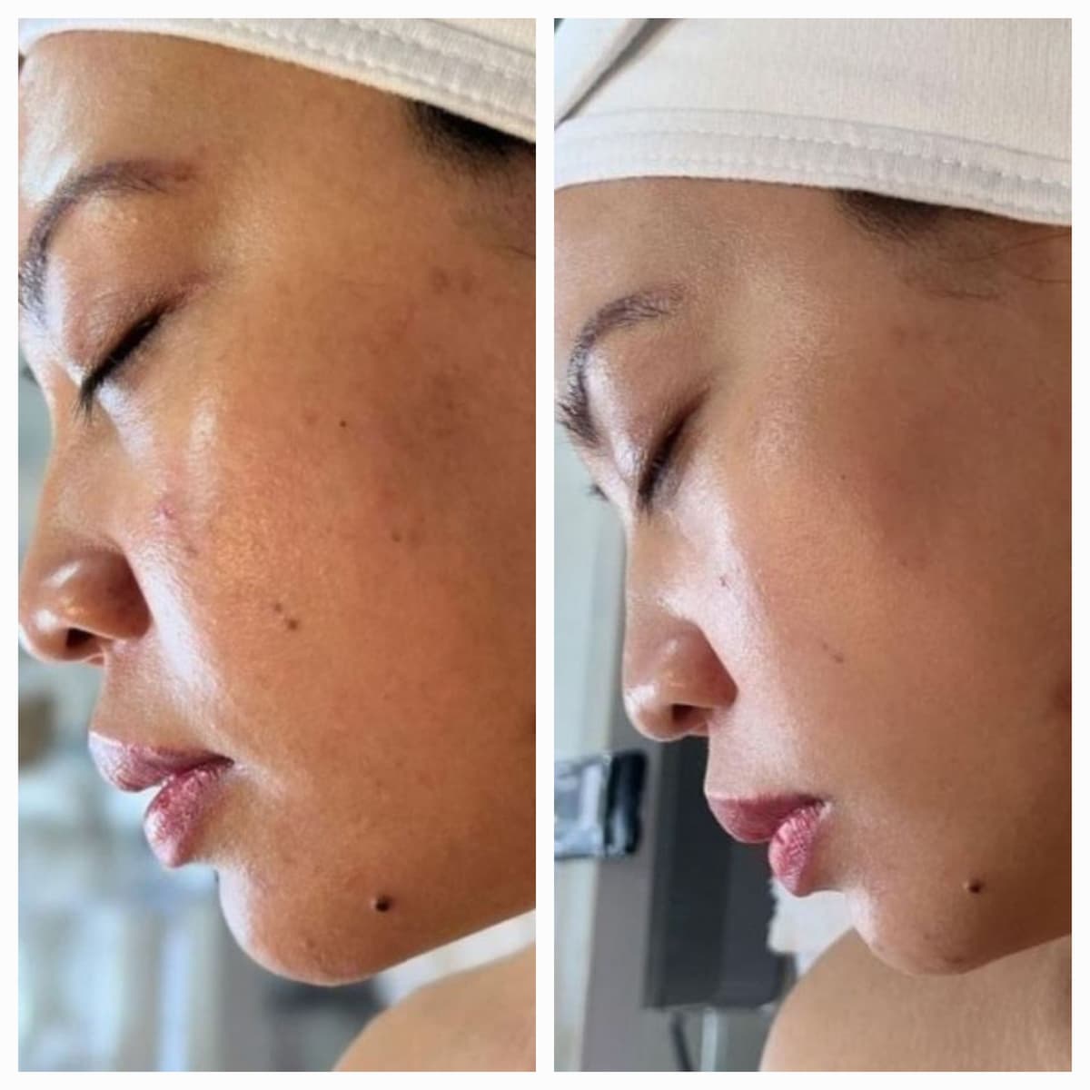 Acne Treatment results - Treatment Area