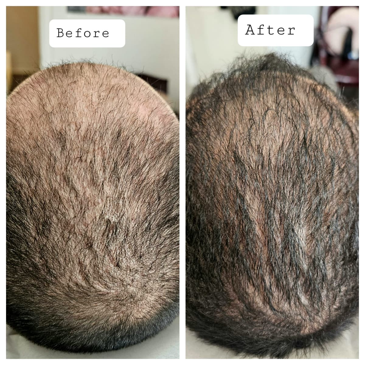 Hair Growth Treatment results - Scalp