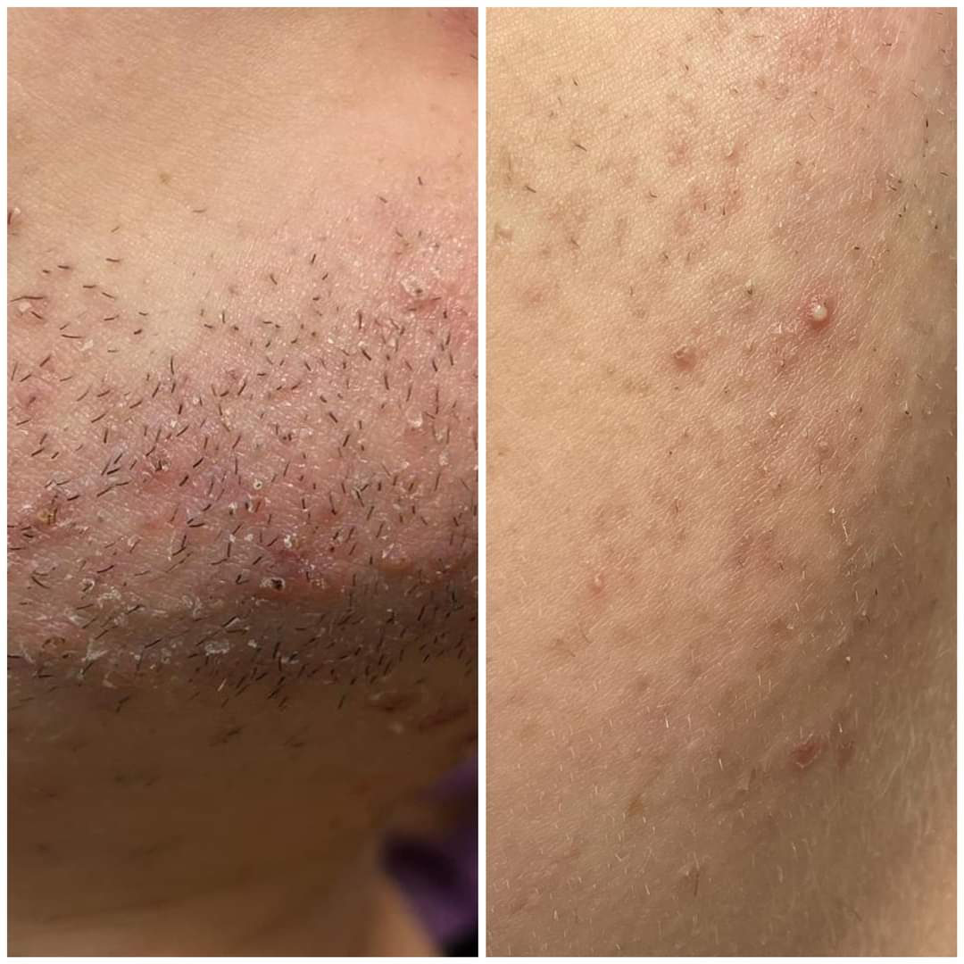 Full Body Laser Hair Removal results - Treatment Area