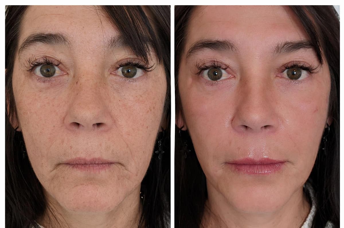 Micro-Needling with Accelerator Serum results - Treatment Area